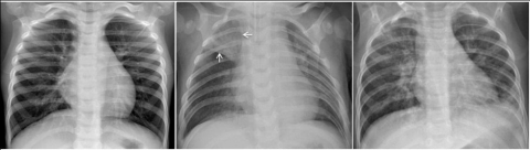 Deep Learning Models for Pneumonia Identification and Classification ...