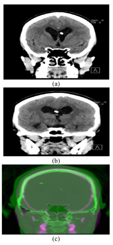 Detection Of Brain Tumor Based On Multimodality Brain Image Fusion ...